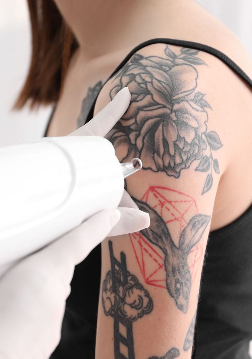 Laser Tattoo Removal Services in Madison MS